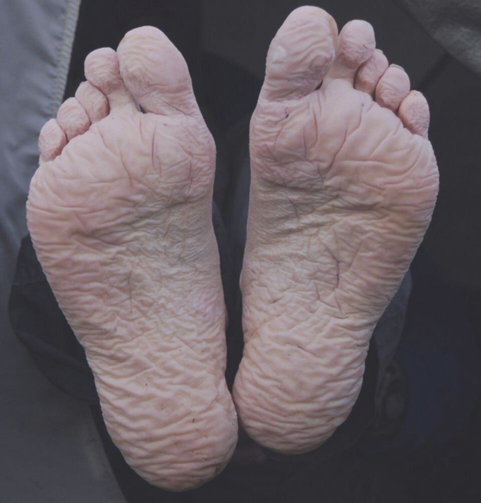 7 Masalah Kaki yang Sering Dialami Pendaki